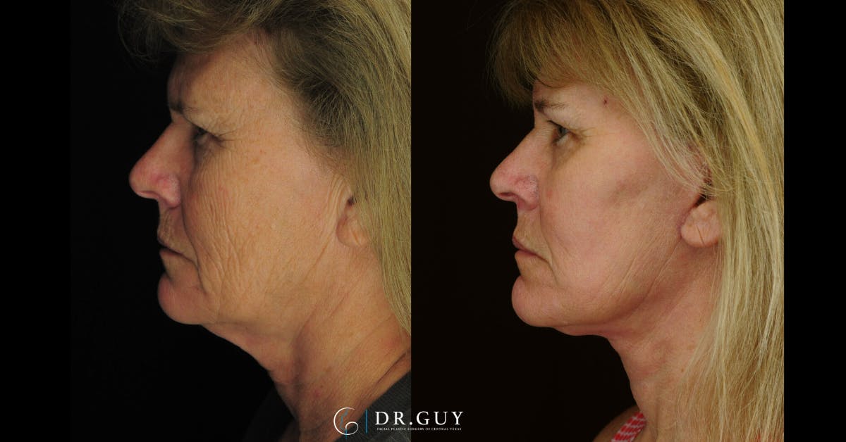 Facelift Before & After Gallery - Patient 310670 - Image 5