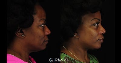 Facelift Before & After Gallery - Patient 326928 - Image 1