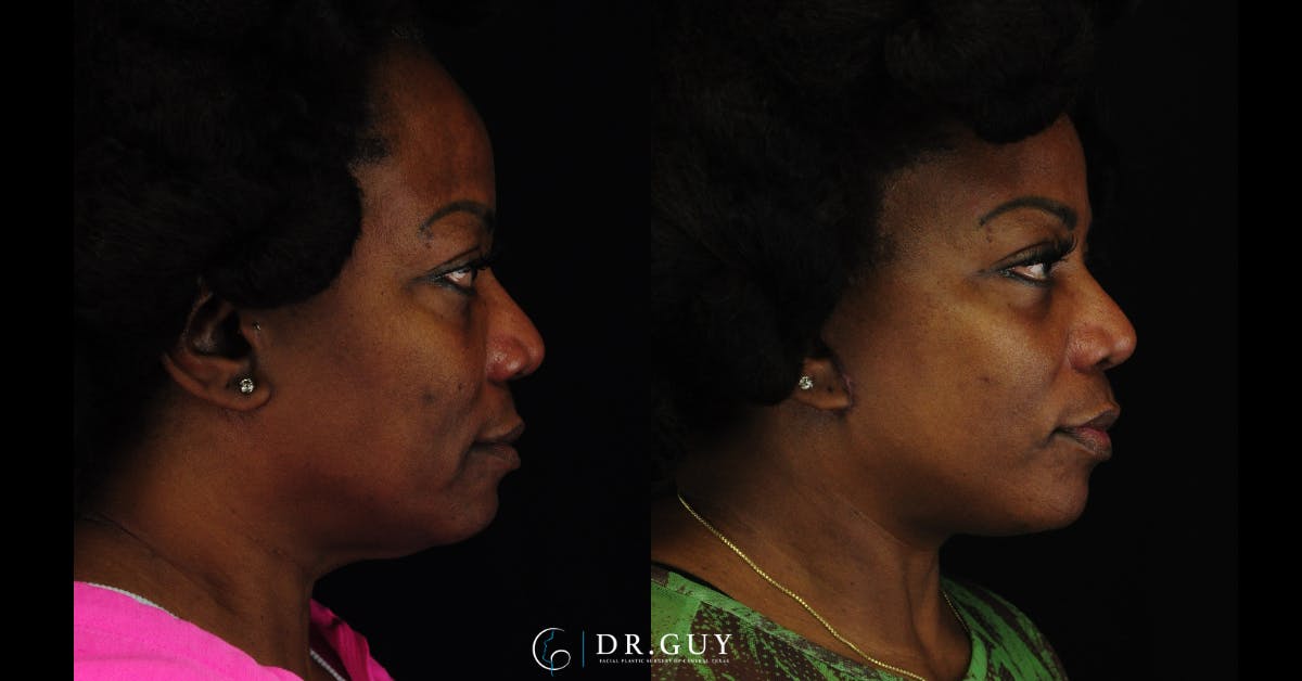 Facelift Before & After Gallery - Patient 326928 - Image 1