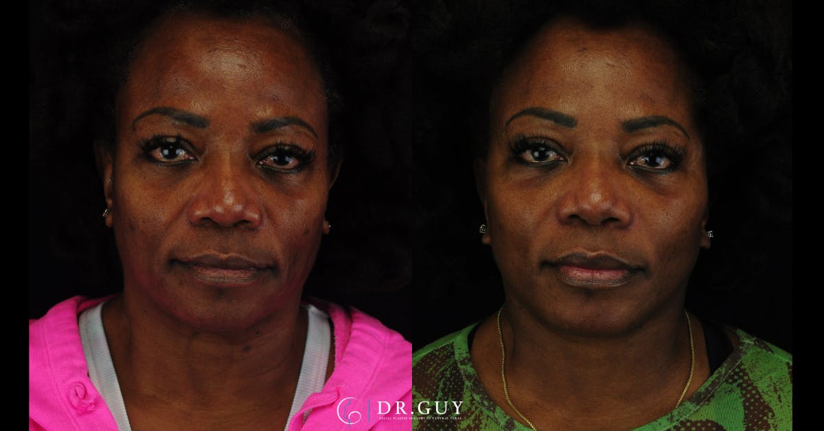Facelift Before & After Gallery - Patient 326928 - Image 2