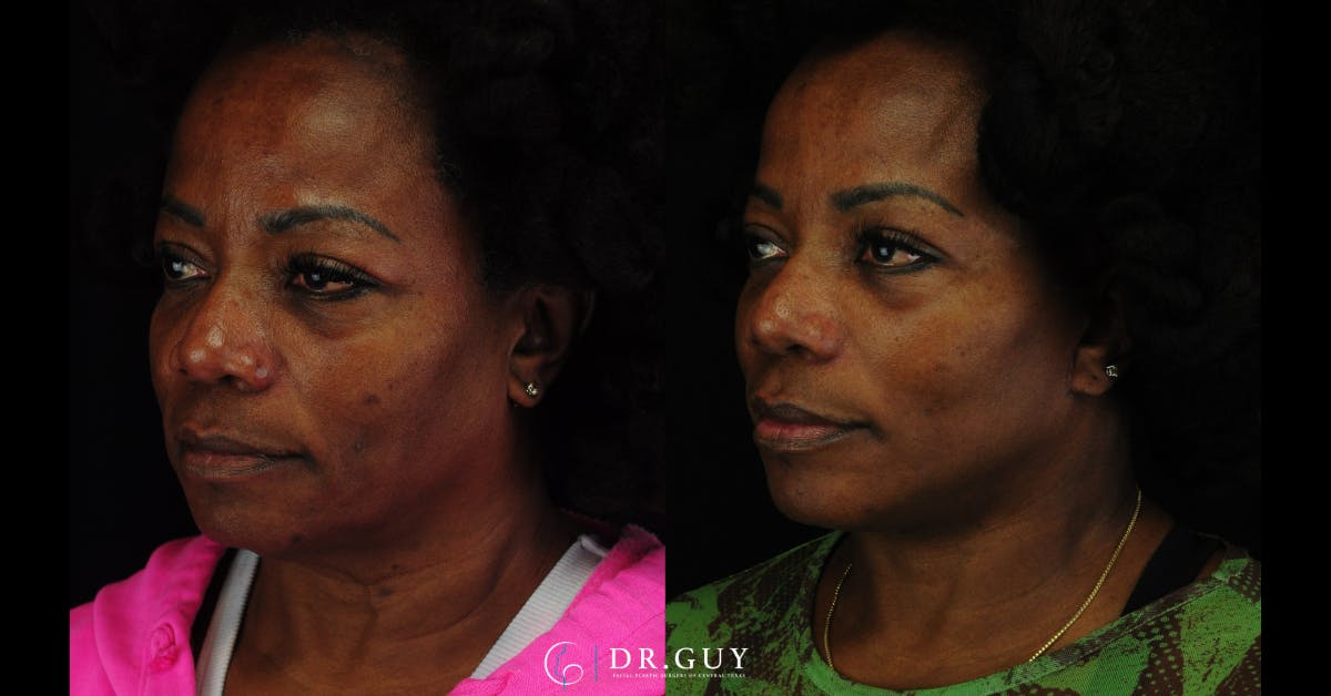 Facelift Before & After Gallery - Patient 326928 - Image 3