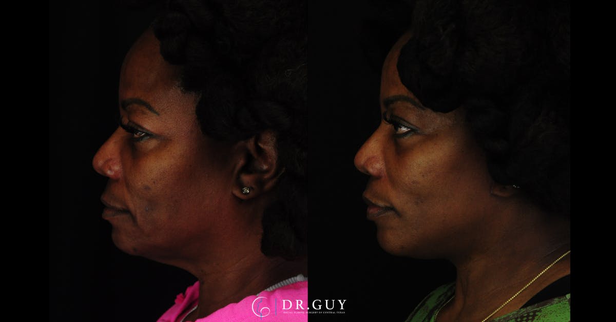 Facelift Before & After Gallery - Patient 326928 - Image 4