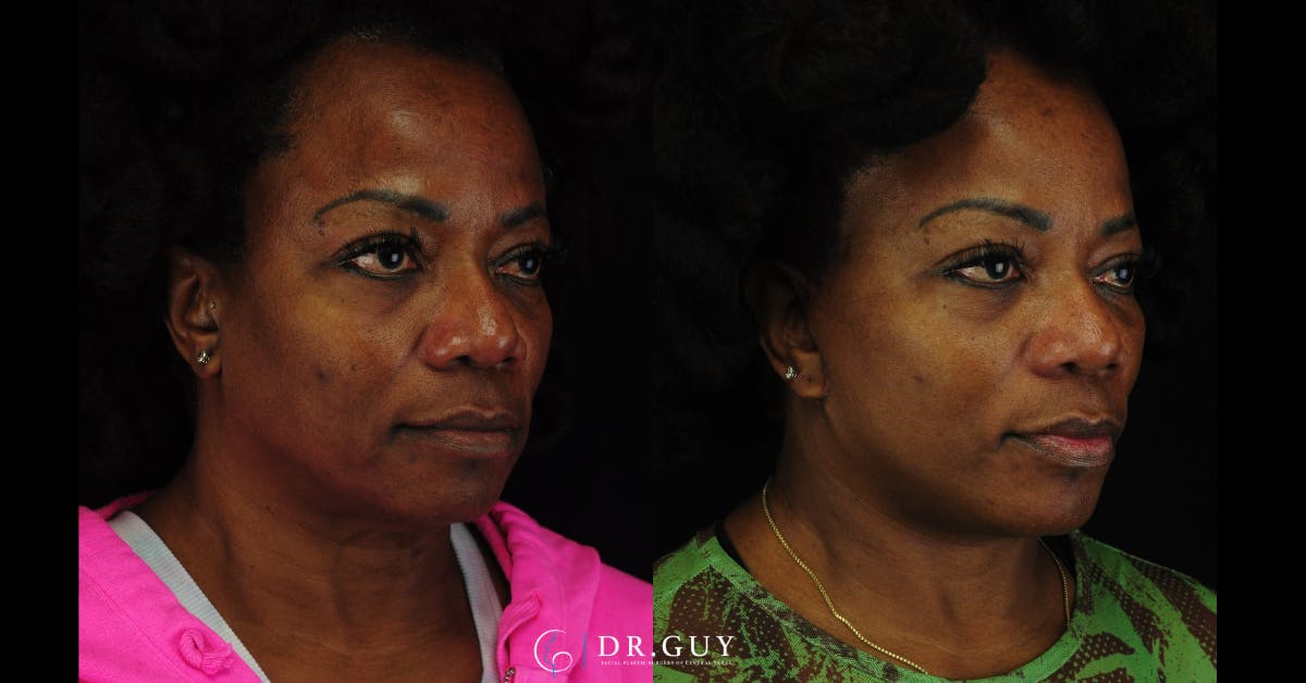 Facelift Before & After Gallery - Patient 326928 - Image 5