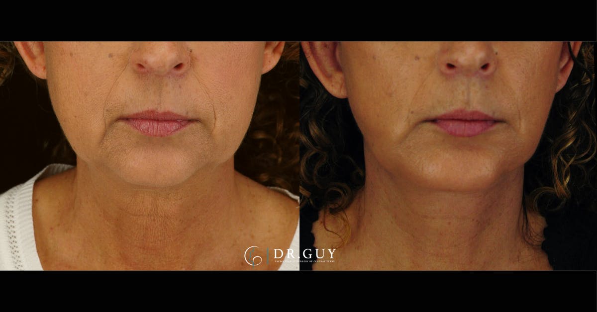 Facelift Before & After Gallery - Patient 327605 - Image 3