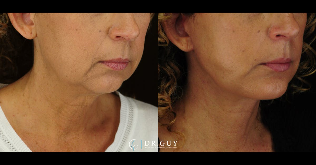 Facelift Before & After Gallery - Patient 327605 - Image 4