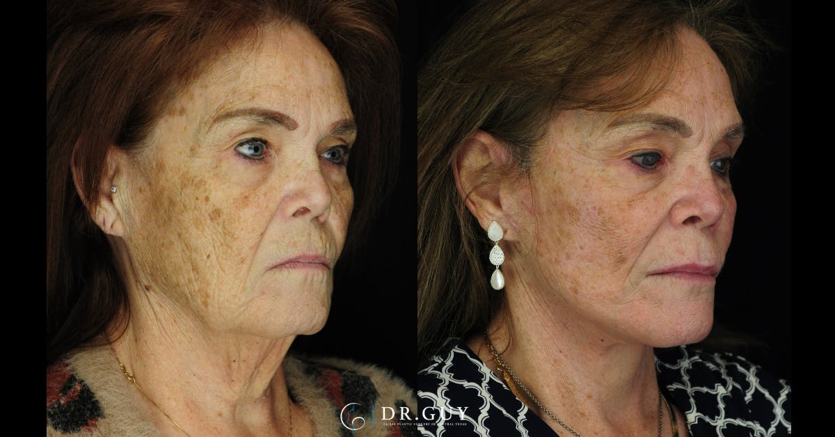 Facelift Before & After Gallery - Patient 268300 - Image 1