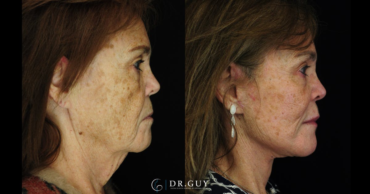 Facelift Before & After Gallery - Patient 268300 - Image 2