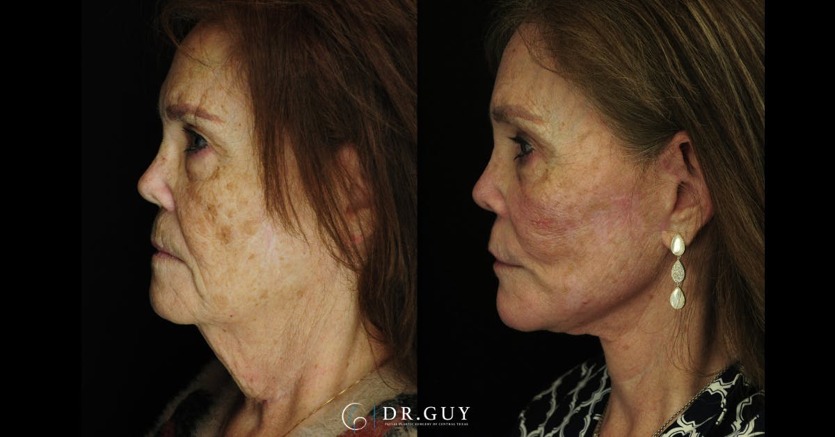 Facelift Before & After Gallery - Patient 268300 - Image 5
