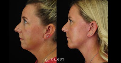 Facelift Before & After Gallery - Patient 356335 - Image 1