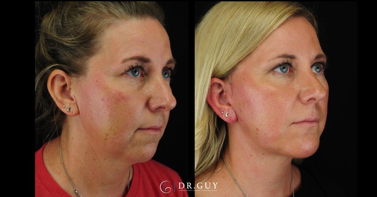 Facelift Before & After Gallery - Patient 356335 - Image 5