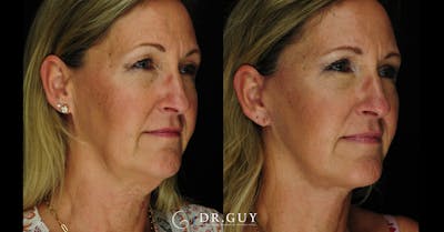 Facelift Before & After Gallery - Patient 366105 - Image 1