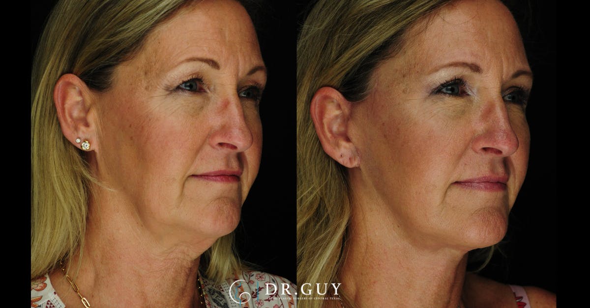 Facelift Before & After Gallery - Patient 366105 - Image 1