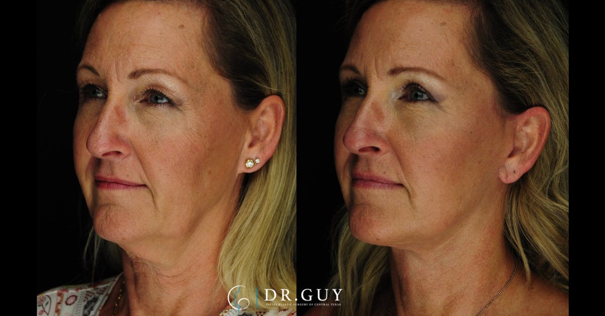 Facelift Before & After Gallery - Patient 366105 - Image 2