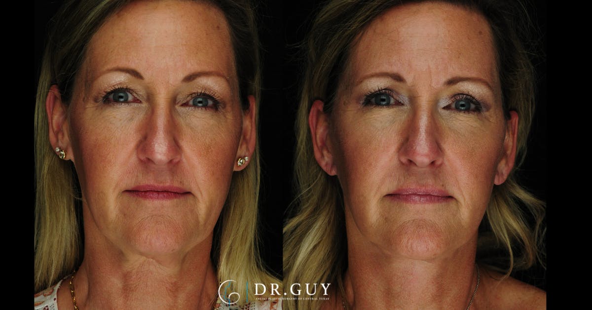 Facelift Before & After Gallery - Patient 366105 - Image 3