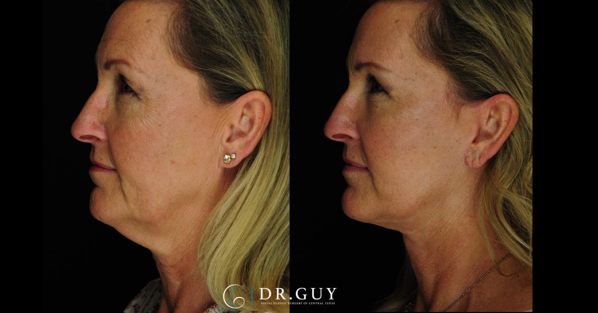 Facelift Before & After Gallery - Patient 366105 - Image 4