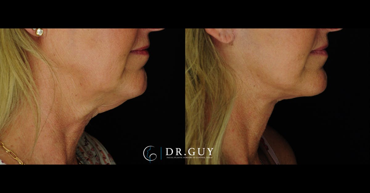 Facelift Before & After Gallery - Patient 366105 - Image 5