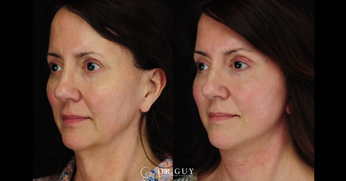 Facelift Before & After Gallery - Patient 379853 - Image 1