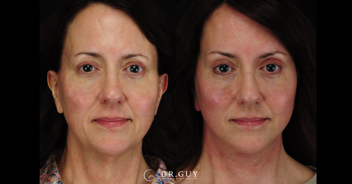 Facelift Before & After Gallery - Patient 379853 - Image 2