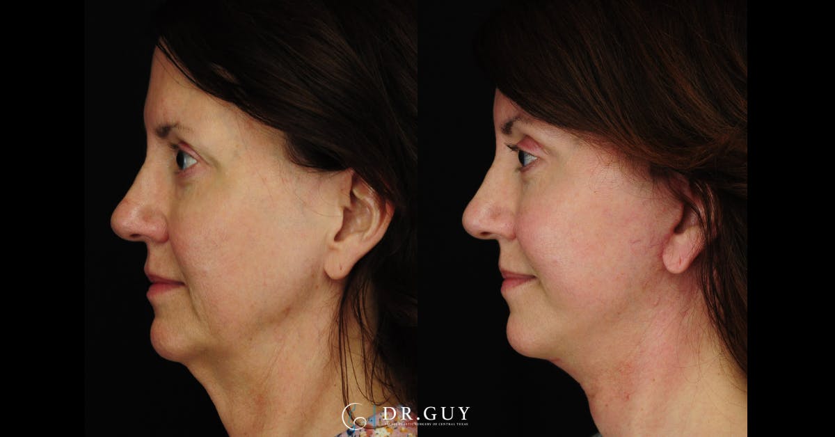 Facelift Before & After Gallery - Patient 379853 - Image 3