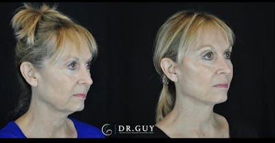 Facelift Before & After Gallery - Patient 166778 - Image 1