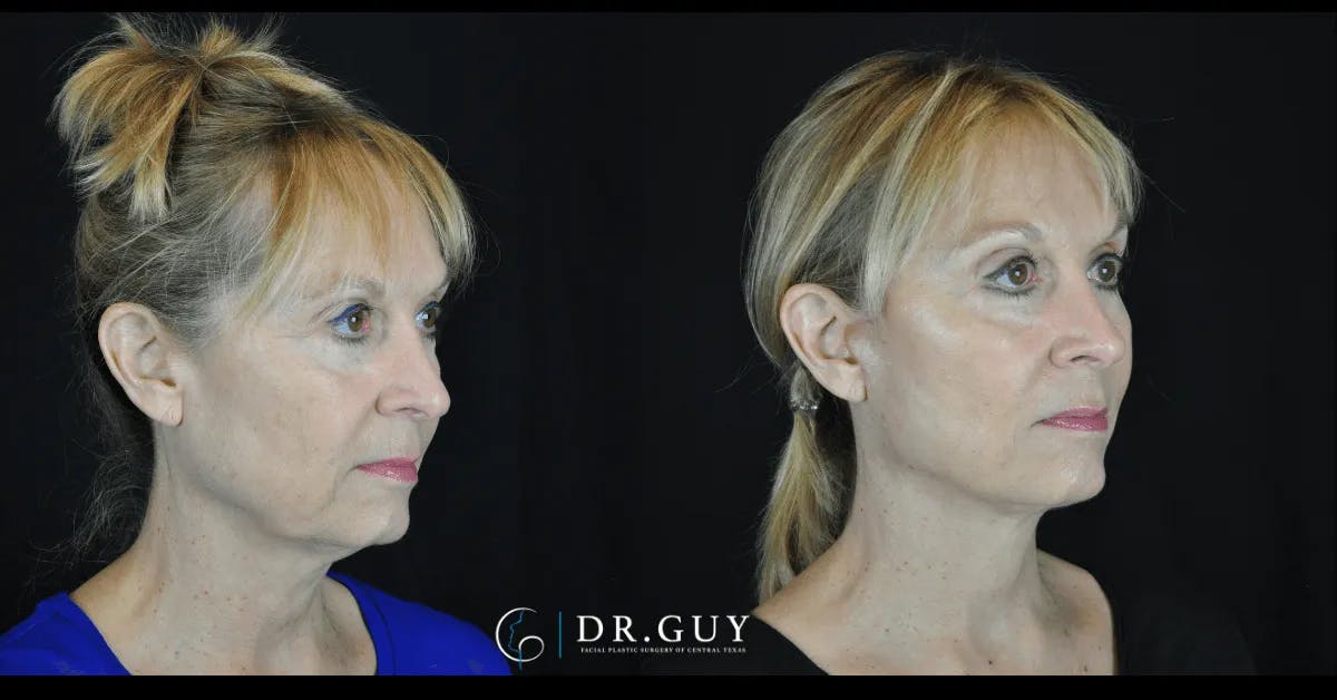 Facelift Before & After Gallery - Patient 166778 - Image 1