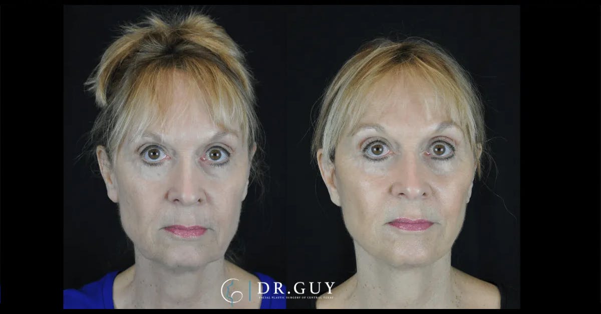 Facelift Before & After Gallery - Patient 166778 - Image 2
