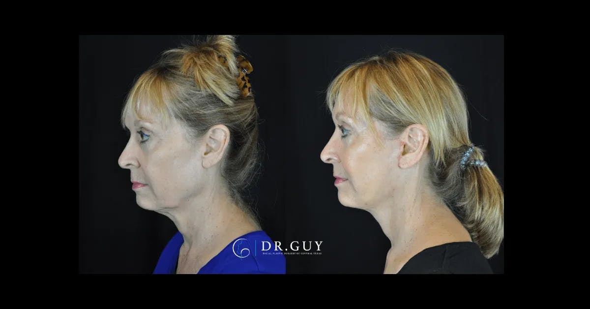 Facelift Before & After Gallery - Patient 166778 - Image 3