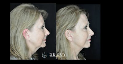 Facelift Before & After Gallery - Patient 444348 - Image 1