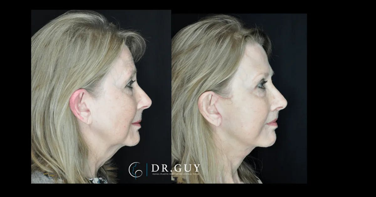 Facelift Before & After Gallery - Patient 444348 - Image 1