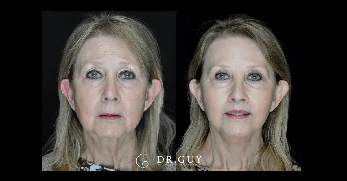 Facelift Before & After Gallery - Patient 444348 - Image 3