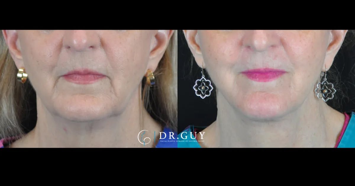 Facelift Before & After Gallery - Patient 104667 - Image 1