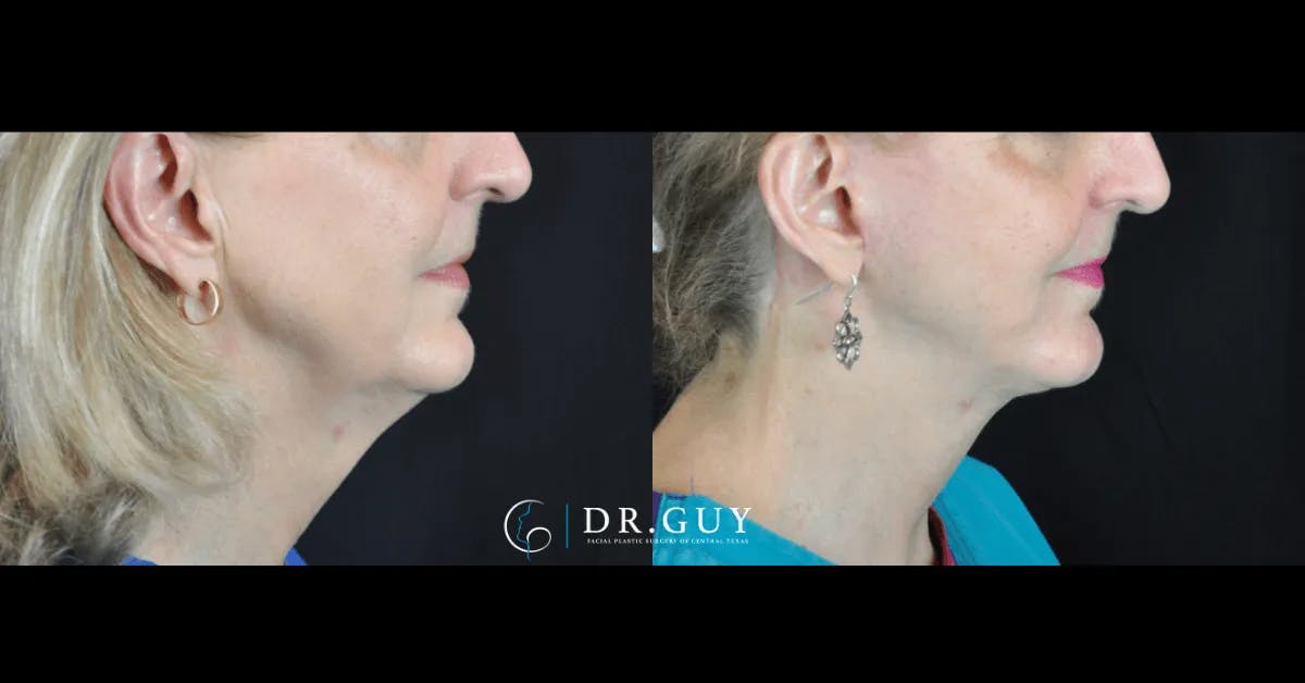 Facelift Before & After Gallery - Patient 104667 - Image 2