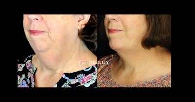 Facelift Before & After Gallery - Patient 311466 - Image 1