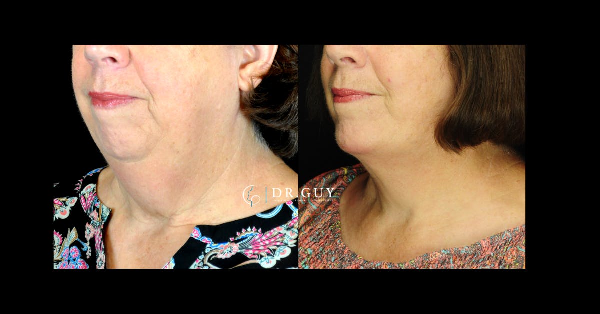 Facelift Before & After Gallery - Patient 311466 - Image 1