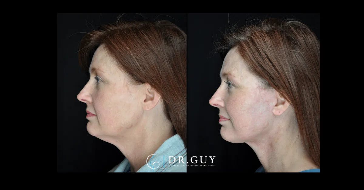 Facelift Before & After Gallery - Patient 240887 - Image 1