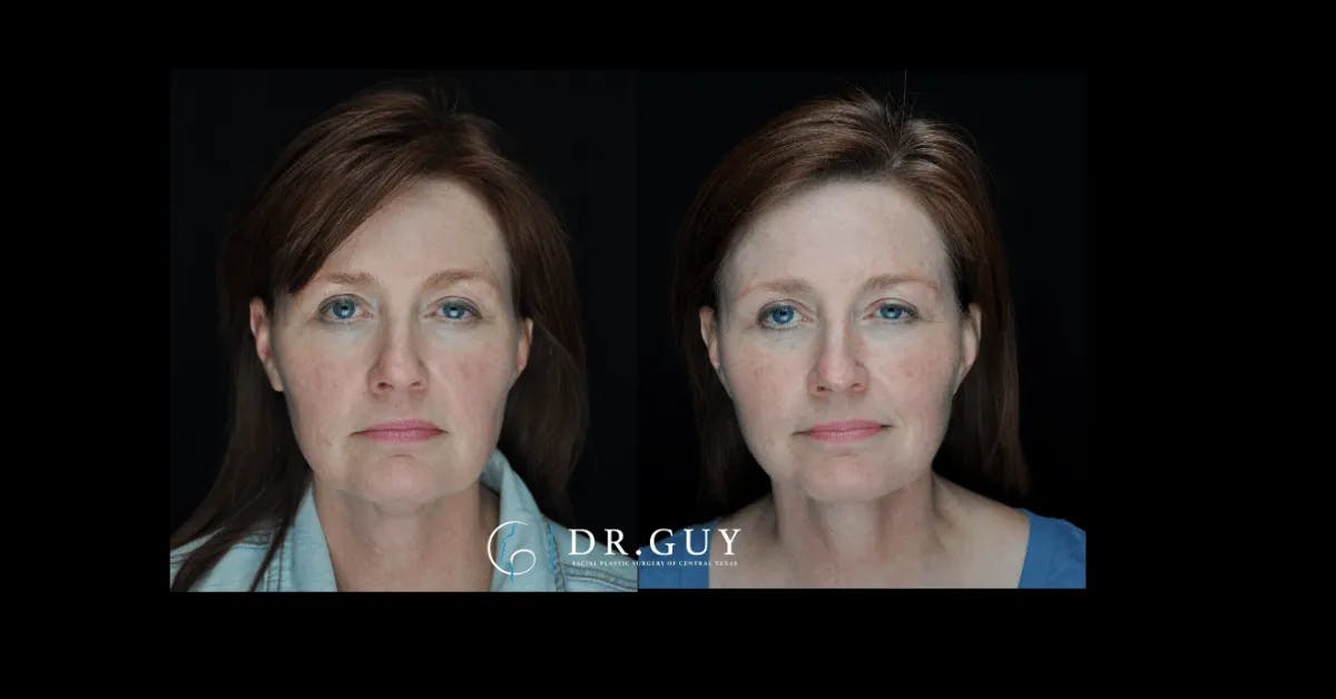 Facelift Before & After Gallery - Patient 240887 - Image 2