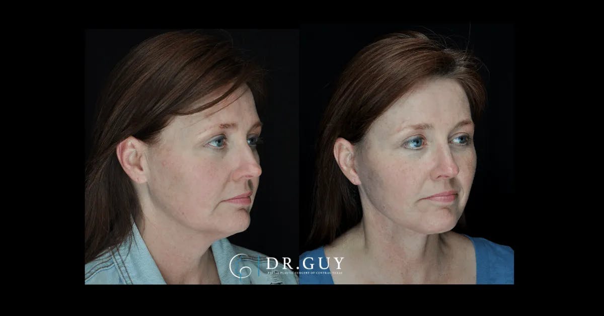 Facelift Before & After Gallery - Patient 240887 - Image 3
