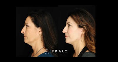 Facelift Before & After Gallery - Patient 347666 - Image 1