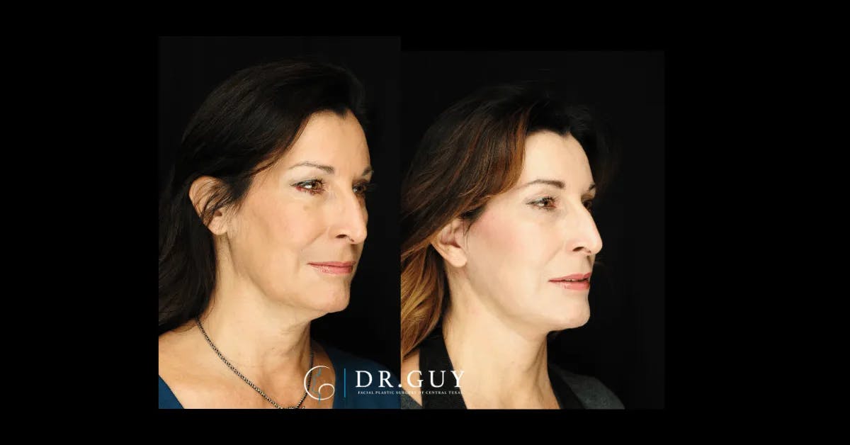 Facelift Before & After Gallery - Patient 347666 - Image 2