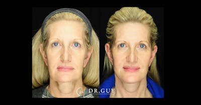 Facelift Before & After Gallery - Patient 173547 - Image 1