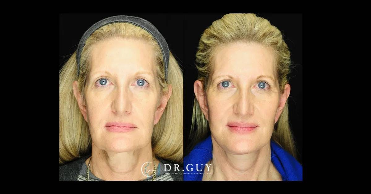 Facelift Before & After Gallery - Patient 173547 - Image 1