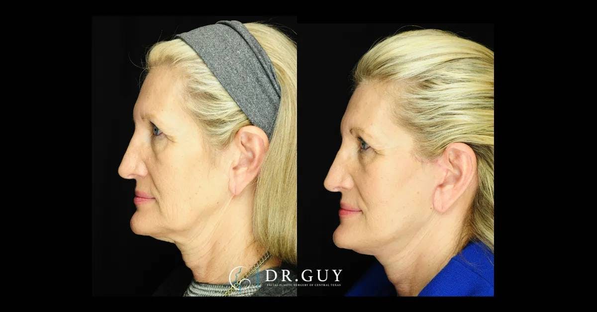 Facelift Before & After Gallery - Patient 173547 - Image 2