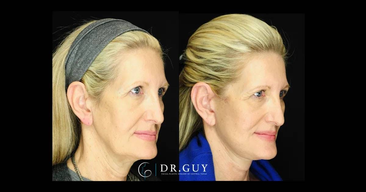 Facelift Before & After Gallery - Patient 173547 - Image 3