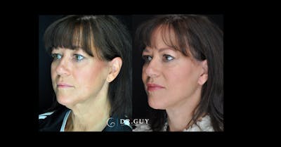 Facelift Before & After Gallery - Patient 366838 - Image 1