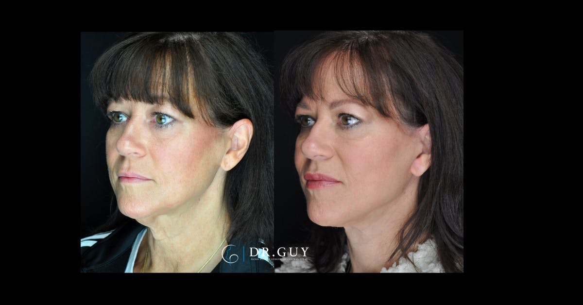 Facelift Before & After Gallery - Patient 366838 - Image 1