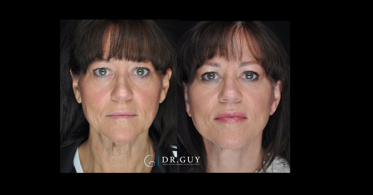 Facelift Before & After Gallery - Patient 366838 - Image 2