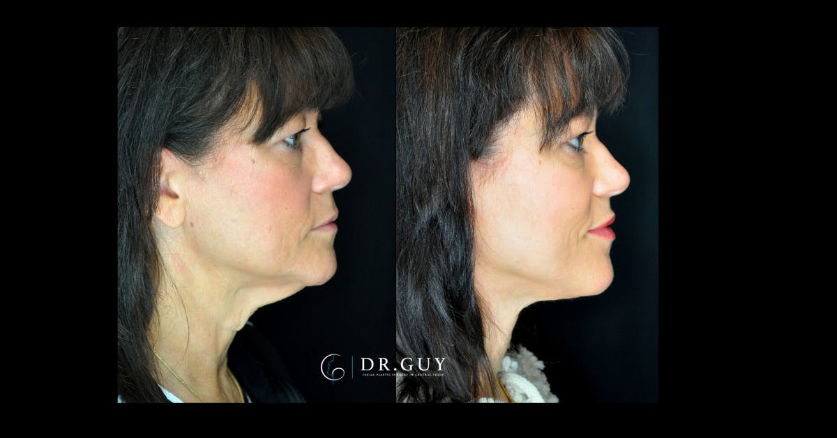 Facelift Before & After Gallery - Patient 366838 - Image 3