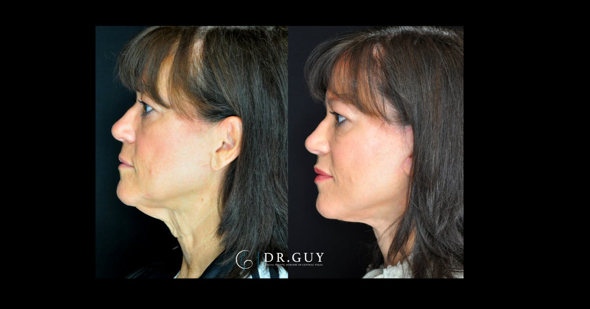 Facelift Before & After Gallery - Patient 366838 - Image 4