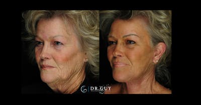Facelift Before & After Gallery - Patient 253717 - Image 1