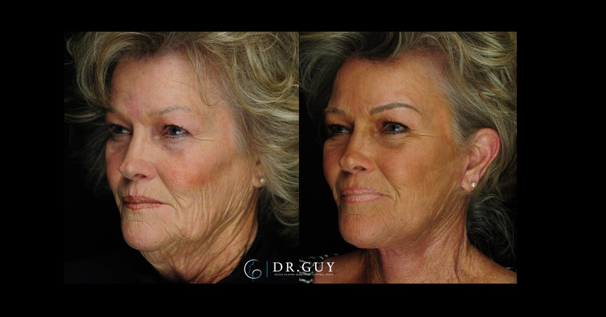 Facelift Before & After Gallery - Patient 253717 - Image 1